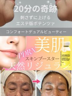・
✨ たった2回でこの変化！ ✨

💎 レモンボトル スキンブースター
　　　　　　✖️
💎 コンフォートデュアル

Wアプローチの相乗効果で、ふっくらハリ艶肌へ💕

目元のクマやお顔のたるみ
年齢とともに気になるお肌のお悩みに✨

🌸 目元のクマが目立ちにくい印象に

🌸 たるみが気になるお肌にハリ感UP

🌸 内側から満たされたようなふっくら肌へ

🌸 失われがちな艶と潤いをチャージ

🌸 いきいきとした若々しい印象に

今回のお客様は、わずか2回の施術で
目元やお肌の印象に嬉しい変化が見られました✨

美容成分で潤いを与えるレモンボトルのスキンブースターと温熱ケアでハリをサポートするコンフォートデュアル。

2つの美容ケアを組み合わせることで
年齢肌に多角的にアプローチ💗

「隠す肌」から「魅せたくなる素肌」へ。

鏡を見るのが楽しみになるような
艶やかでふっくらとしたお肌を目指しませんか？✨
今なら両方で、¥17,600🥰

※施術による変化には個人差があります。

#レモンボトル #スキンブースター #コンフォートデュアル #クマケア #たるみケア