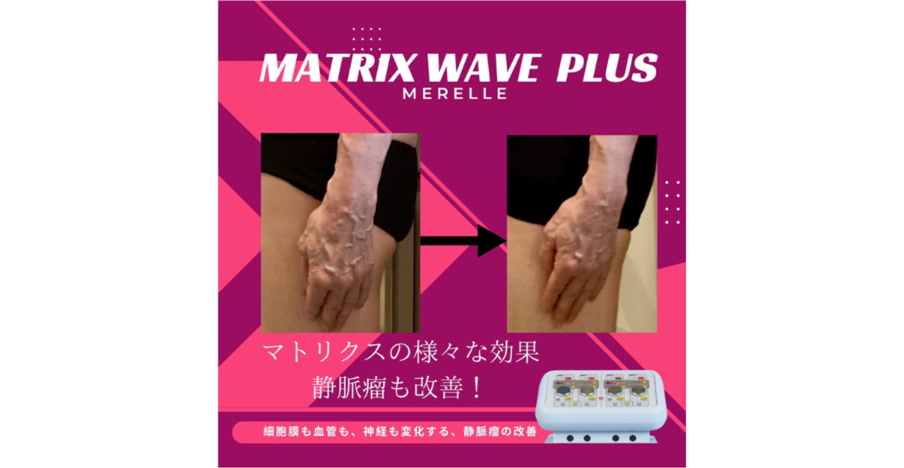 マトリクス ウェーブ プラス | Merelle soin esthetic